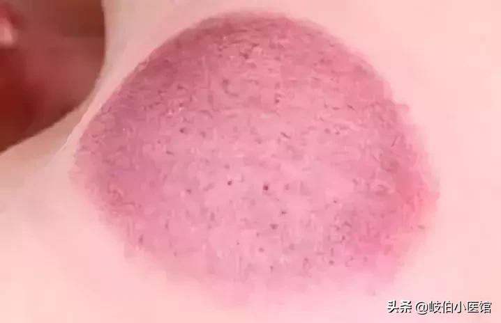 中医火罐疗法有哪些注意事项,中医火罐穴位图