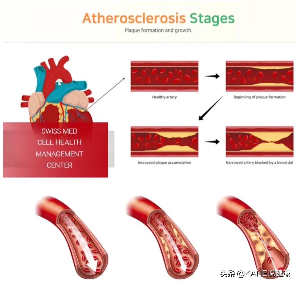 血液净化能控制血栓吗,血液净化真的能排油吗