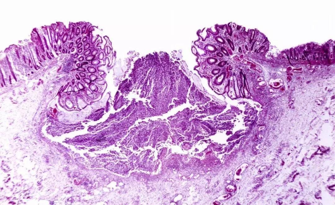 扩张型心肌病心衰是怎么回事,扩张型心肌病没什么症状