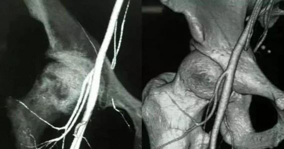 为什么股骨颈骨折后肌肉会掉,为什么髋臼骨折会导致股骨头坏死