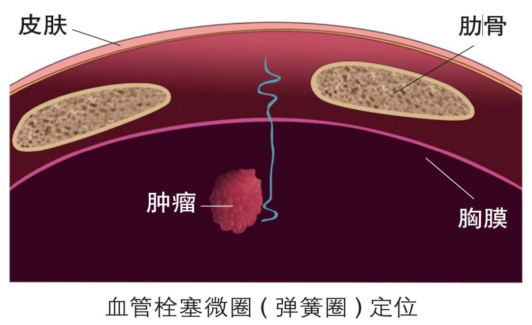 肺结节干预最佳时机,肺结节太大了中医怎么治