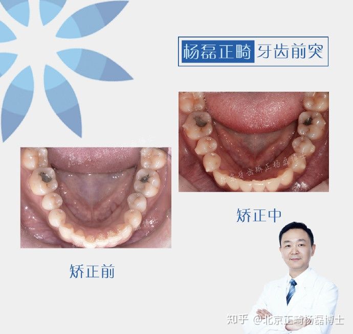拔牙正畸治疗龅牙,门牙外突不拔牙正畸案例