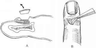 解决甲沟炎比较好的方法,甲沟炎很严重怎么修