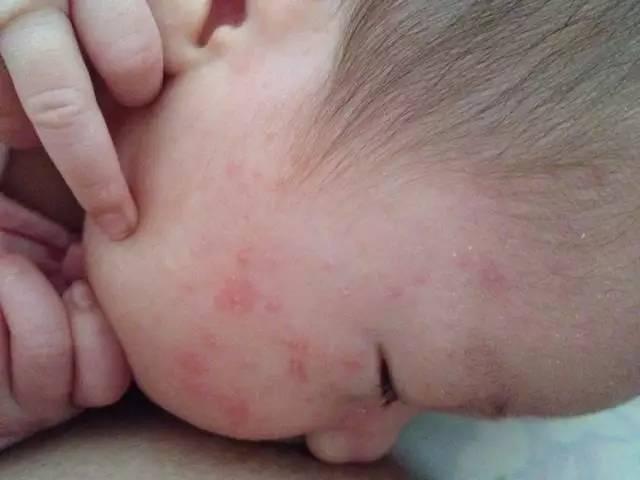 宝宝经常起湿疹食疗方法,宝宝反复湿疹最佳治疗方法