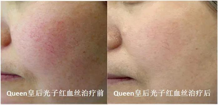 护肤光子嫩肤,光子嫩肤和脱毛操作