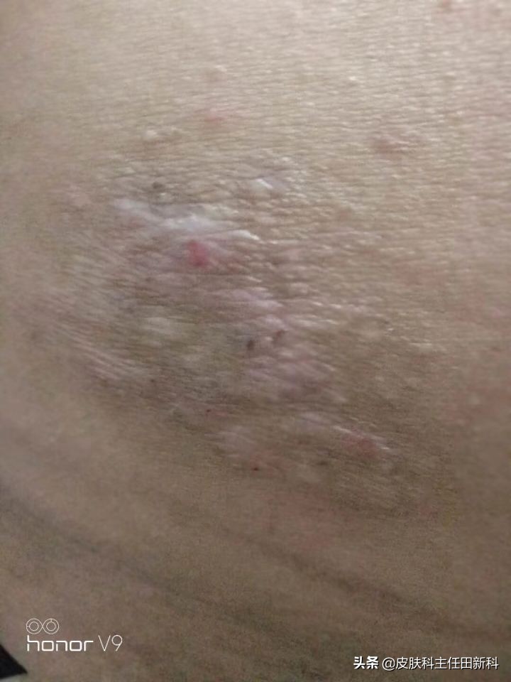 真菌感染性皮肤病原因,人真菌皮肤病怎么治