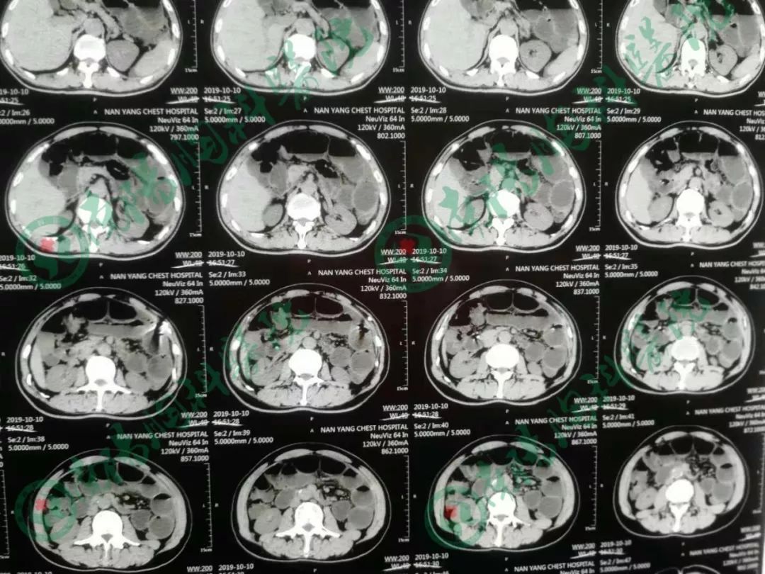 南阳市胸科医院,乌鲁木齐肿瘤医院治直肠癌