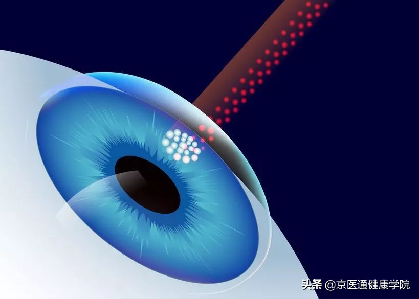 近视手术哪种手术对眼睛伤害小,激光近视手术好还是晶体手术好