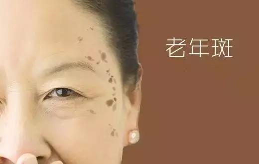 祛斑面诊必背知识点,要祛斑