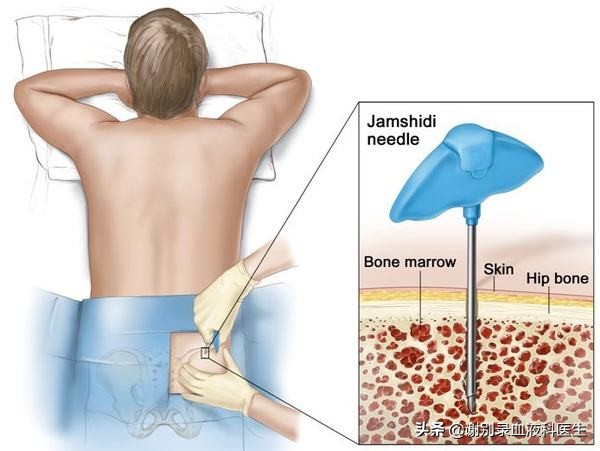做骨穿对身体有后遗症吗,小孩做骨穿的后遗症