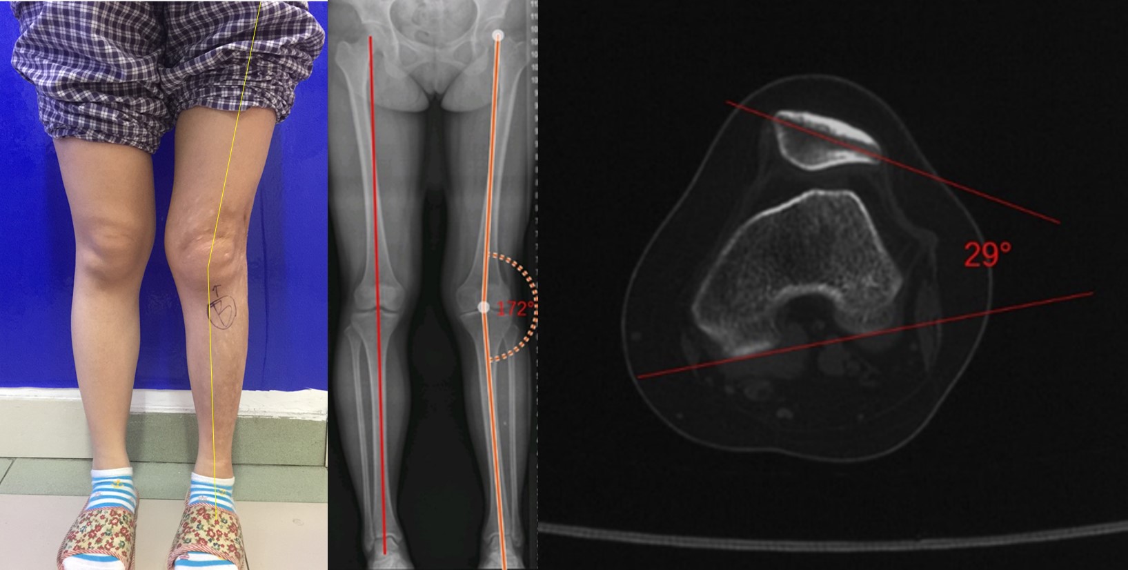 髌骨半脱位打石膏能彻底治愈吗,青少年膝盖半月板二级损伤