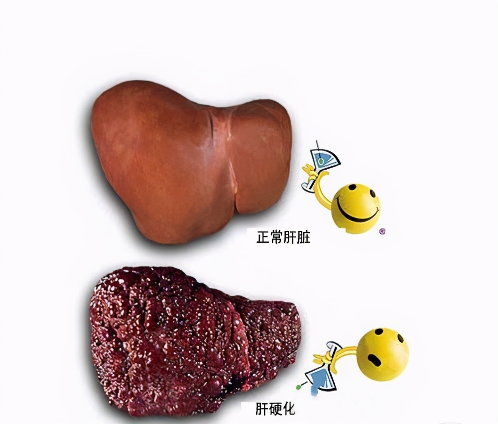 肝炎肝硬化肝癌的演变过程,乙肝肝硬化肝癌三部曲要吃什么药