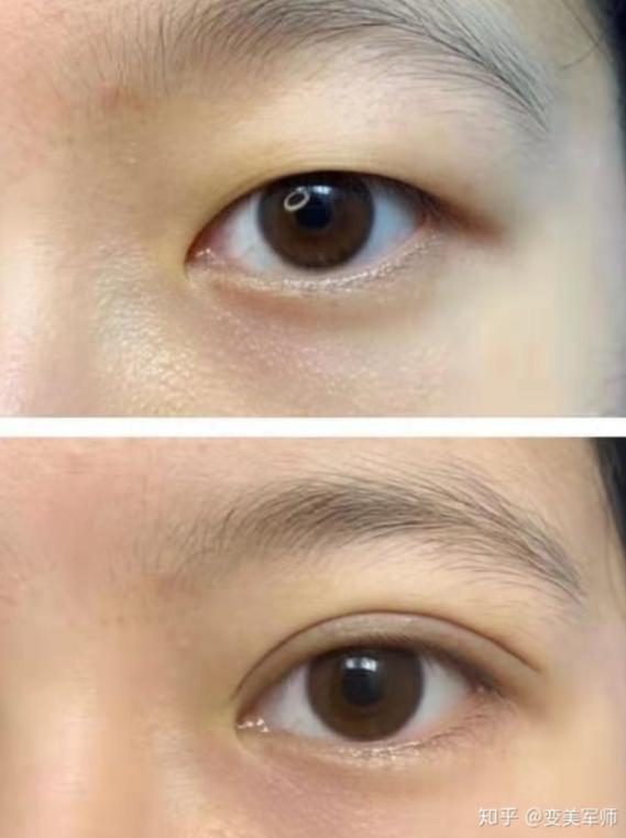 眼睛太圆了怎么修复双眼皮,眼睛已经是双眼皮太小了怎么变大