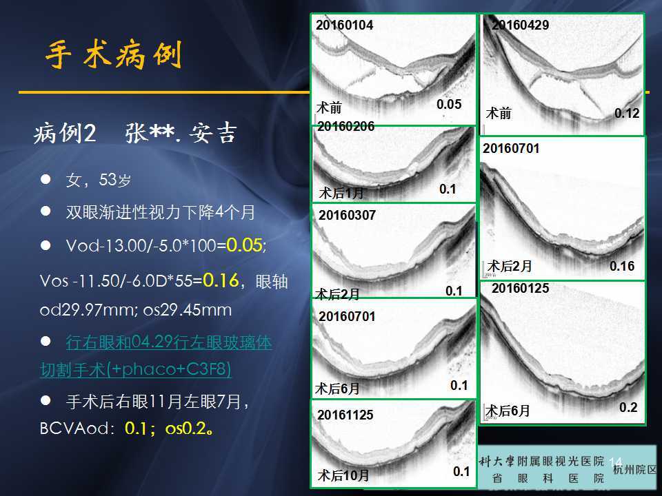 高度近视黄斑劈裂哪家医院好,高度近视黄斑劈裂中医治疗