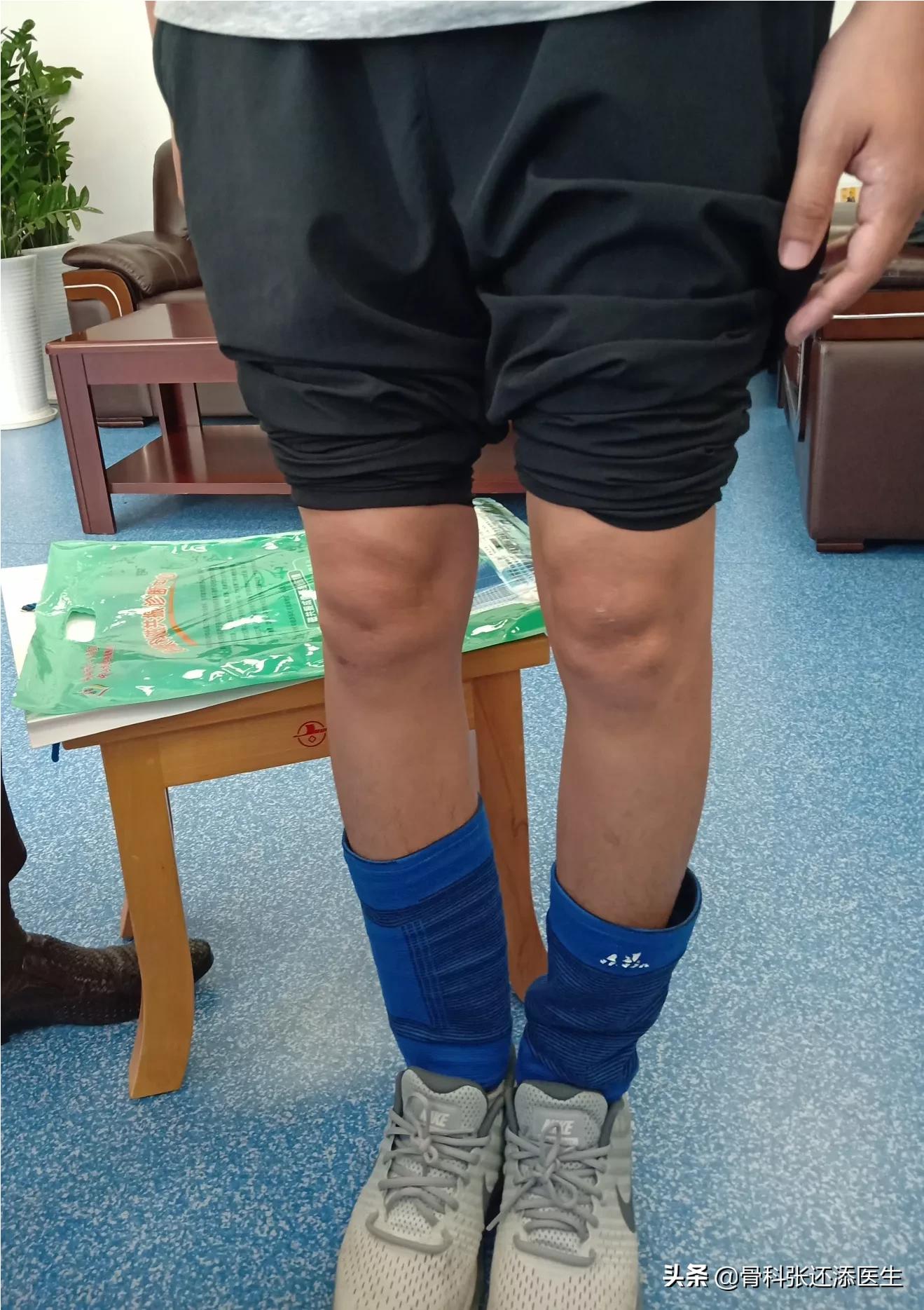 詹姆斯o型腿为什么不手术,詹姆斯罗圈腿为什么膝盖不会受伤