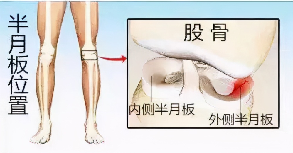 关于半月板的知识,半月板损伤科普小知识