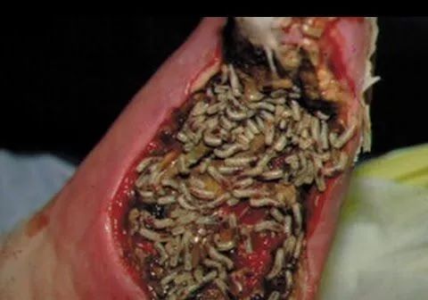 长蛆植入！连抗生素都搞不定的伤口，苍蝇宝宝竟能轻松搞定