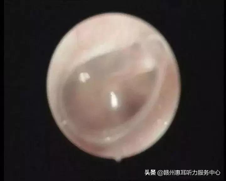 耳硬化症通过什么检查,耳硬化症的诊疗计划