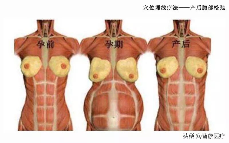 肚子大穴位埋线有效吗,穴位埋线腹部塑形