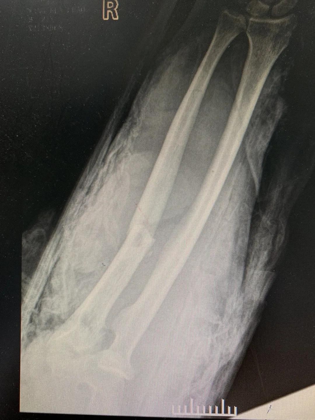 【日照市人民医院】右臂卷入机器被撕裂 6.5小时成功复活