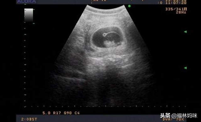 孕检发现孕酮低，胎儿还能保住吗？医生往往会给这样的建议