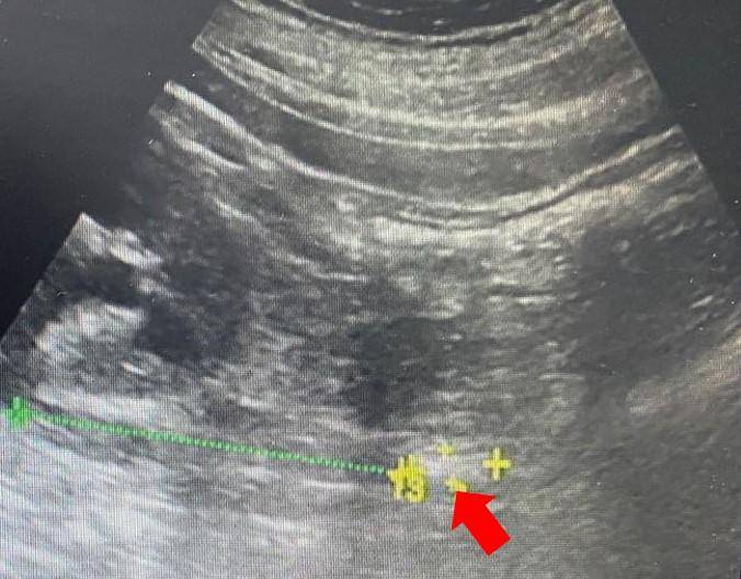 医生说肾里有结石不要紧,有结石为什么彩超照不出来