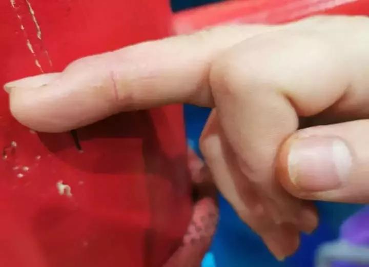 手上脱皮是什么真菌,手上脱皮真菌感染抹什么药膏好