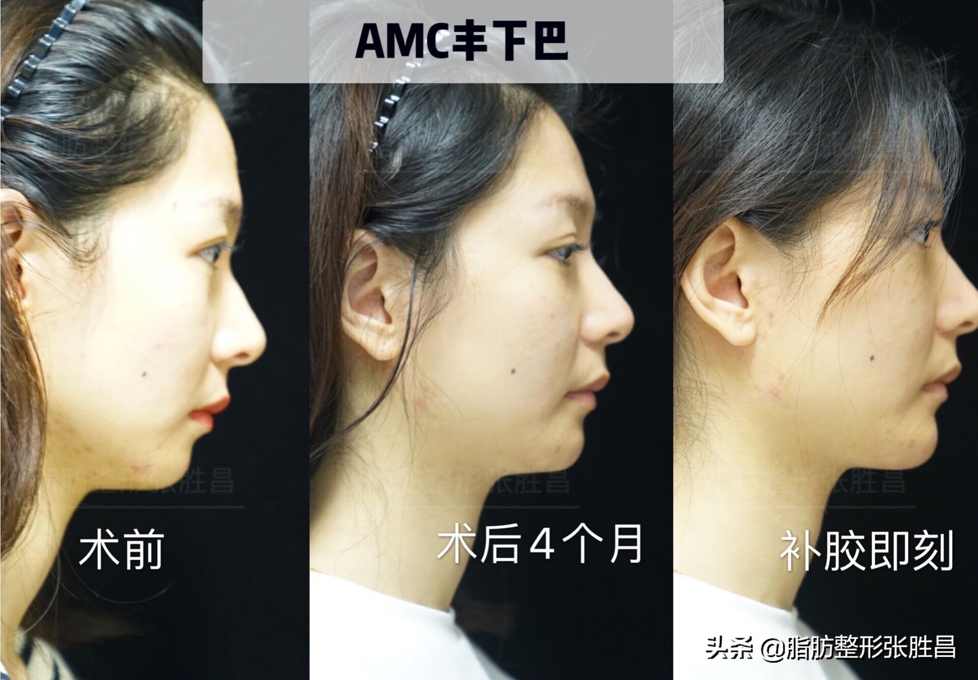 下巴缩短整容女,下巴短小北京