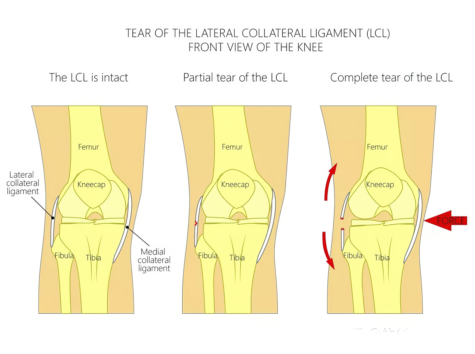 膝关节骨软骨损伤什么原因,膝关节骨关节炎软骨退化康复训练