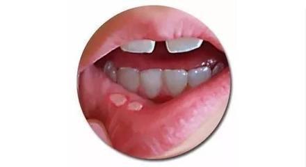 嘴角长泡是上火还是口腔溃疡,口腔内嘴唇起泡是什么原因
