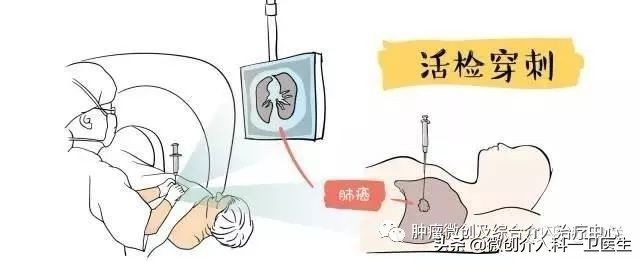 运城市第一医院肿瘤微创及综合介入科，特色技术—肿瘤穿刺活检术