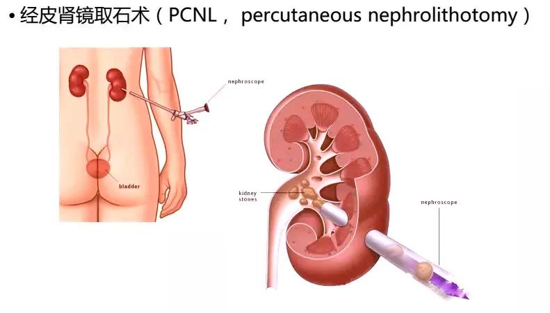 输尿管堵塞引起肾积水还能喝水吗,为什么喝水可以排出结石