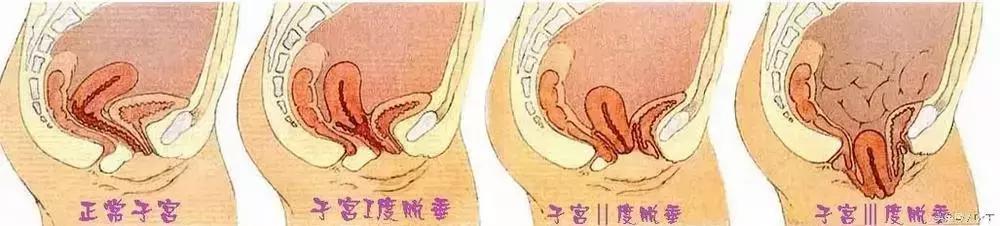 束腹带产后的正确绑法,经常用束腹带绑肚子会瘦吗