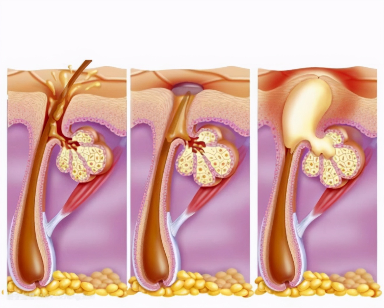 “危险三角区”的痘痘千万不能挤！有人挤了一下，结果留下后遗症