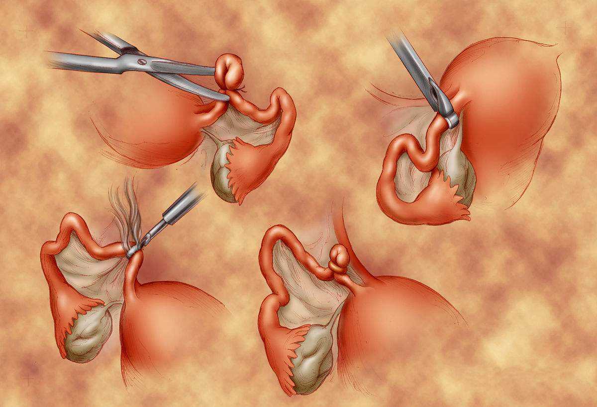 生娃以后，上环还是结扎？哪种避孕方式对女人更好？