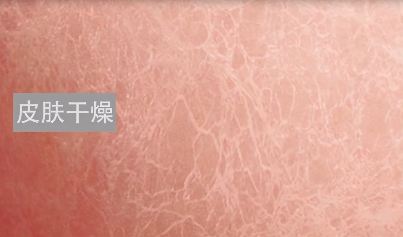 得了鱼鳞病能要小孩吗,得了鱼鳞病还得了银屑病