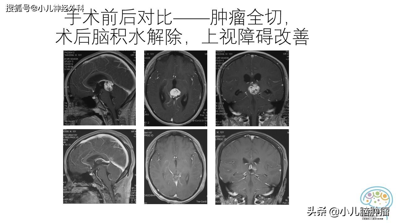 颅内肿瘤引起脑积水，是不是都要做分流手术