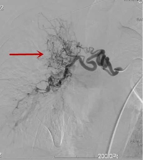 一产妇手术台上大出血死亡,一产妇大出血急需血小板去世