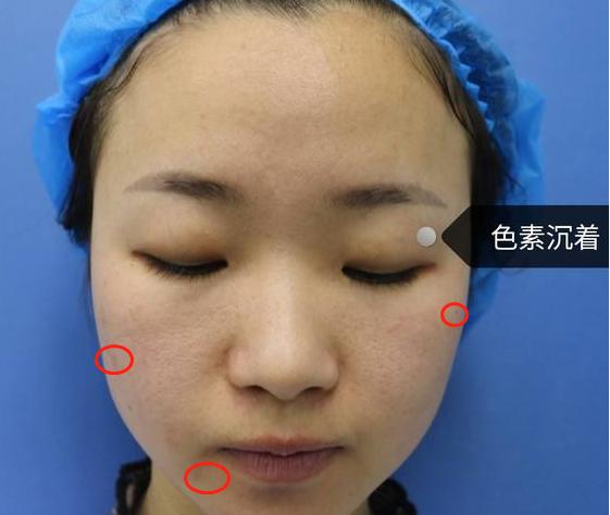 激光美白全身的步骤,激光美白可以美白多少