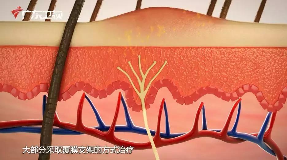 主动脉夹层手术后会猝死吗,主动脉夹层破裂猝死有救吗