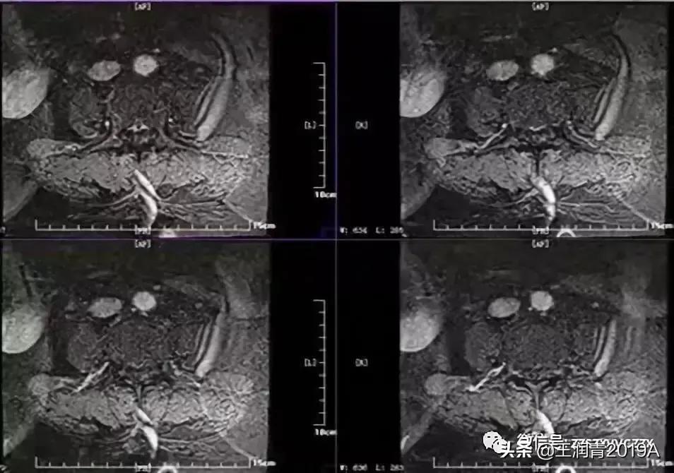 弯腰捡东西,腰痛腿麻大小便*禁失**,竞是腰椎间盘髓核脱出惹的祸