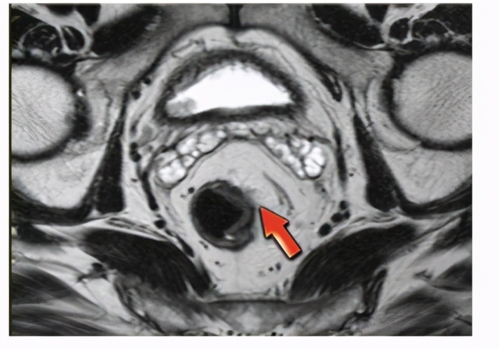 直肠癌术后复发影响因素研究进展,直肠癌术后局部复发病例怎么诊断