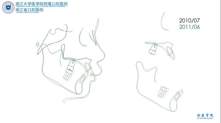 儿童9岁下颌后缩矫治,高角下颌后缩怎么矫治