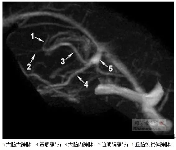 学习|颅脑静脉解剖及引流
