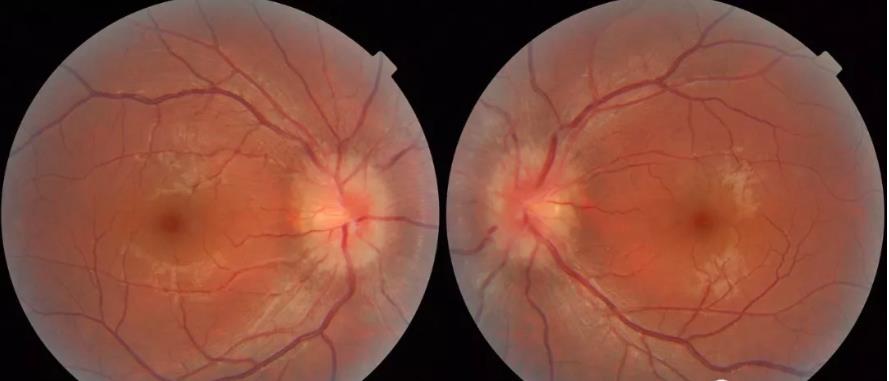 颅高压第一篇:视乳头水肿