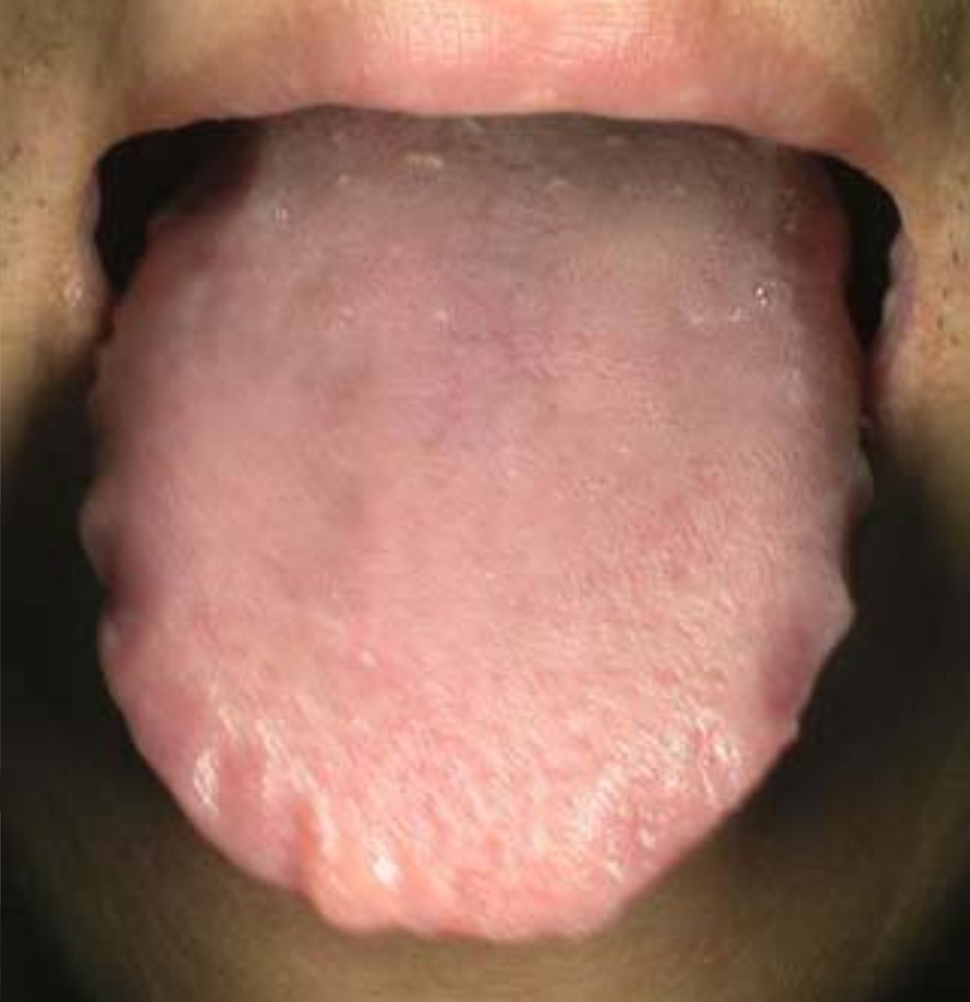 脸部油腻长痘是哪有湿气,脸部出油起疙瘩是什么原因