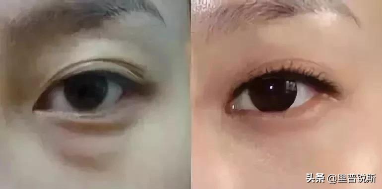 祖传药膏去除眼袋,祖传治疗眼袋