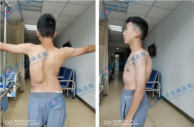 关爱脊柱健康儿童脊柱侧弯,关注脊柱侧弯让孩子少走弯路