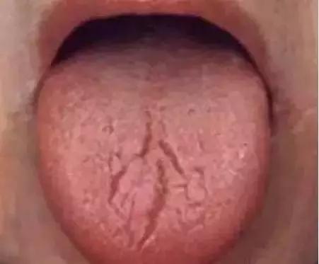 舌头出现信号对身体有什么危险,舌头出现这种症状就要警惕生病了