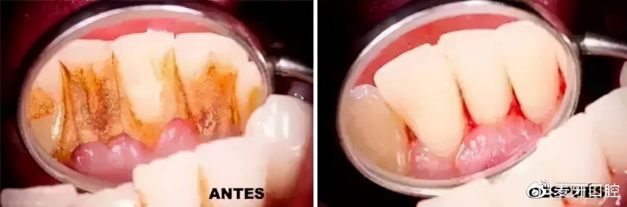 吃肉塞牙牙缝臭怎么办,总是塞牙牙缝臭